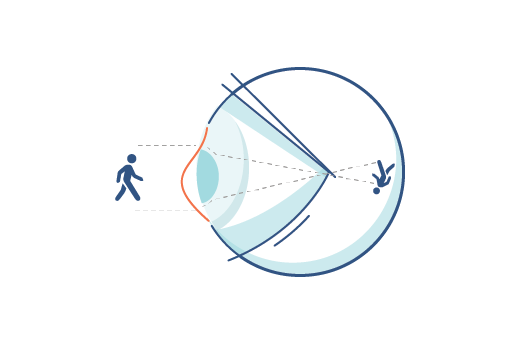 Illustration of an irregular cornea.